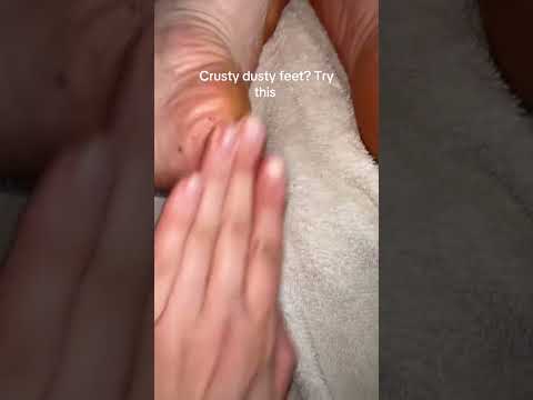 I Took Off All My Dead Foot Skin 🤯 | Dr. Melaxin Peel Shot
