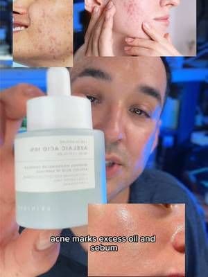 Azelaic acid is one of those ingredients I keep finding more reasons to use. Simple, versatile, and very easy to work into a routine. @SKIN1004 US #skin1004 #centella #TikTokMadeMeBuyIt #azelaicacid #acneproneskin