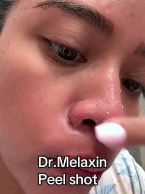 Glassy skin in minutes ✨ Peel, glow, repeat 💆♀️ #DrMelaxin #GlassySkin #SkincareThatWorks #TikTokShopFinds #GlowUp”