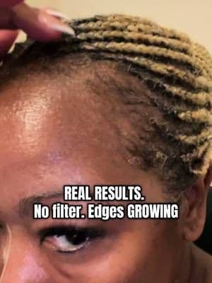 I was one more wig away from losing my whole hairline… but thank God for this serum 🙌🏽✨ I started on July 26 and BABY—my edges are back and thriving 😭💁🏽♀️ No filter. No hype. Just real growth. Especially on my right temple where the damage was the worst. This right here? A non-negotiable in your routine if you wear wigs, braids, or slick backs. Drop a 🔥 if you’re tired of seeing your edges on your bonnet. 💀 #BeBodywise #HairGrowthJourney #EdgesOnFleek #GrowBackEdges #WigLifeRecovery #TikTokMadeMeBuyIt #RealResults #beforeandafter #backtoschool