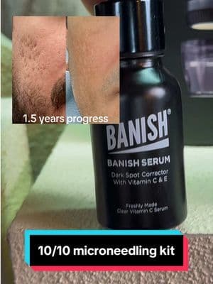 Banish’s formulations only have the essential ingredients, so you aren’t layering junk on your skin. They made pure and fresh with the highest quality ingredients and that’s why this system has made it on my permanent routine. ✅ @BANISH #microneedling #scars #acnescars #skincare101 #tiktokshopcreatorpicks