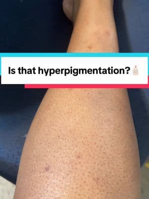 Glow like a star, even if your day feels like a Monday! 🌟✨ Brighten up your skin and your spirit with our hyperpigmentation hero! @Dr.Melaxin #cosmetics #glowingskin #healthyskin #instagram #love #mua #skincare #skincareaddict #skincareblog #skincareblogger #skincarecollection #skincarecommunity #skincaredaily #skincaregoals #skincarejunkie #skincarekorea #skincarelokal #skincarelover #skincareluxury #skincareobsessed #skincareproduct #skincareproducts #skincareregime #skincareregimen #skincarereview #skincareroutine #skincareroutines #skincaretip #skincaretips #skinhealth #beautytips #beautytipsandtricks #clearskin #cosmetics #fashion #glowingskin #haircut #hairdresser #hairsalon #love #makeuptutorial #mua #nails #salon #salonandspa #salonlife #salontoday #salón #scrubslife #scrubtop #selflove #skin #skincare #skincarelover #skincareproducts #skincareroutine #skincaretips #style #womeninmedicine #work #hyperpigmentation #fy #fyp #fypシ゚viral #viral #tiktok #tiktokshop #tiktokmademebuyit